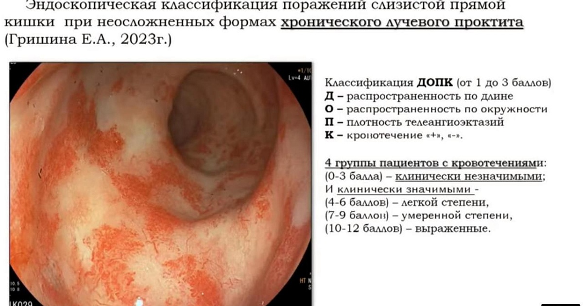 Недостаточность анального сфинктера (анальная инконтиненция)